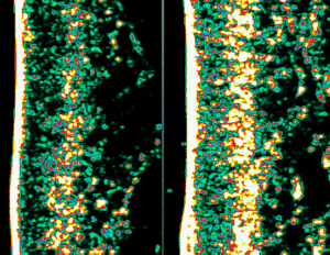 ultrasound picture of collagen levels in skin