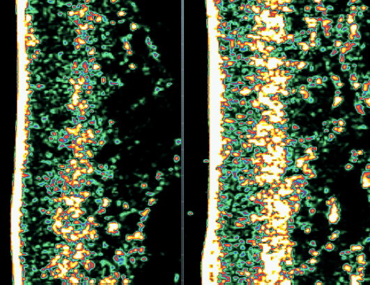 ultrasound picture of collagen levels in skin