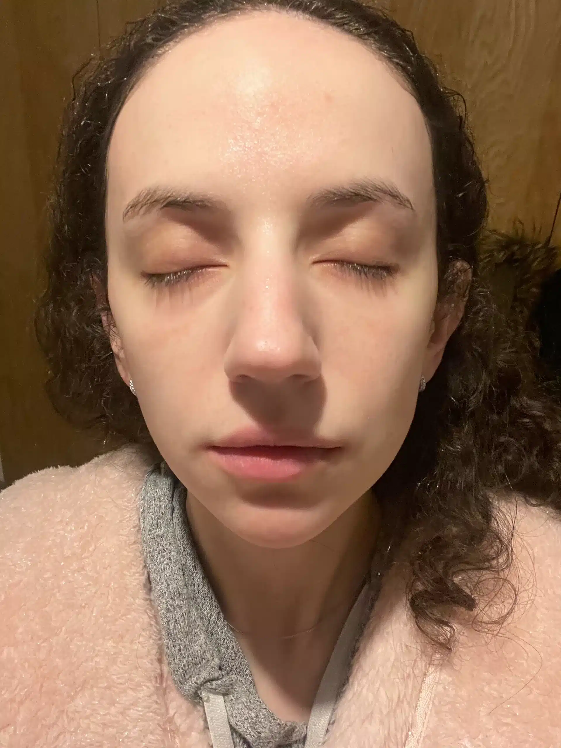 Post-treatment photo after a staged rosacea protocol at Santi London — calmer tone
