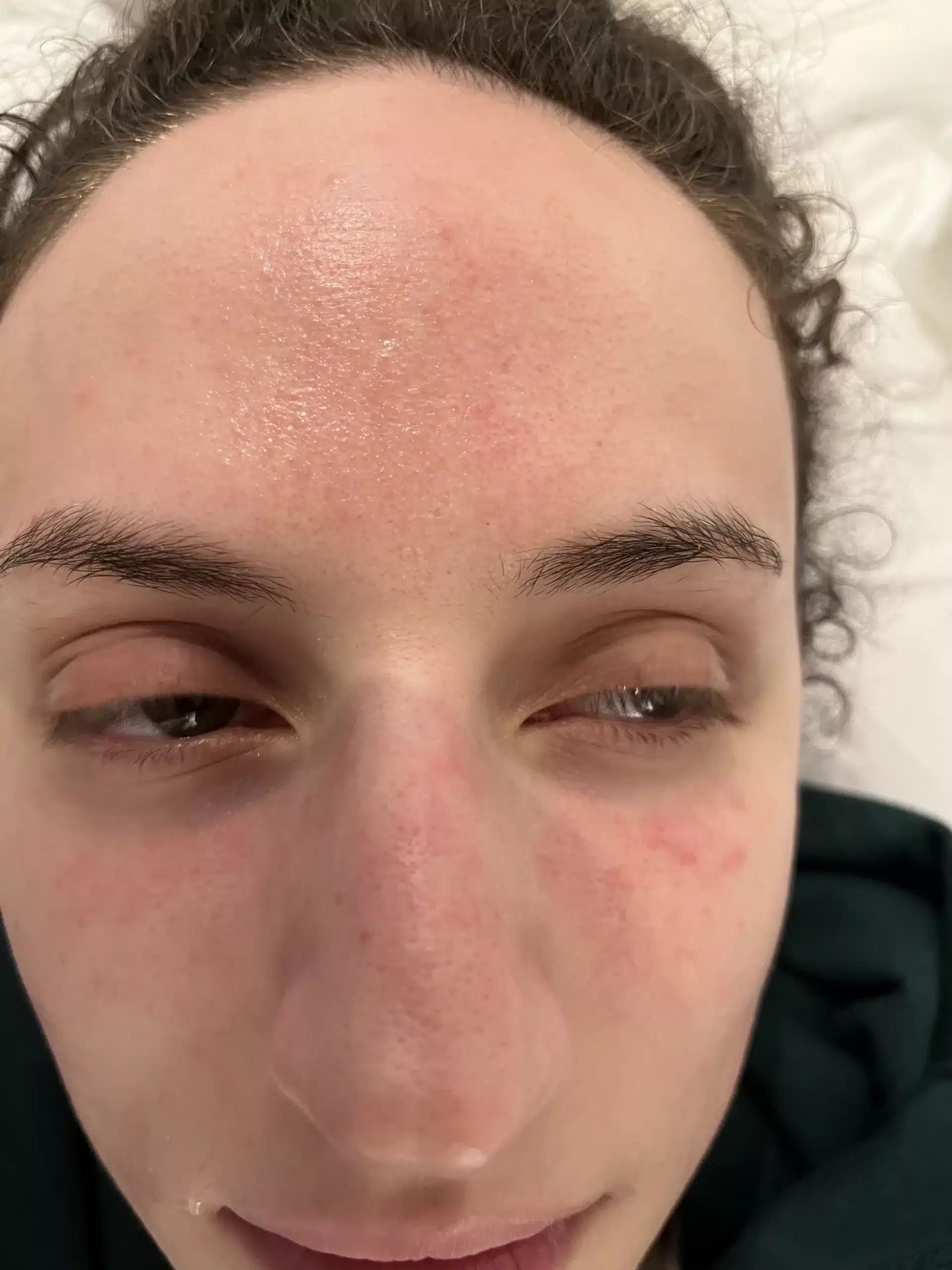 Rosacea presentation before treatment at Santi London — diffuse redness and visible vessels