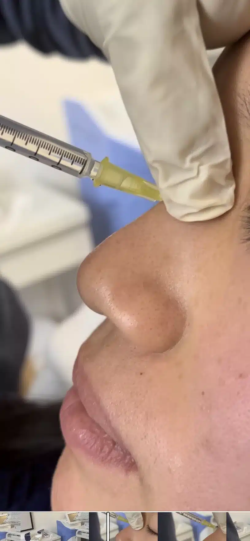 Non-surgical nose