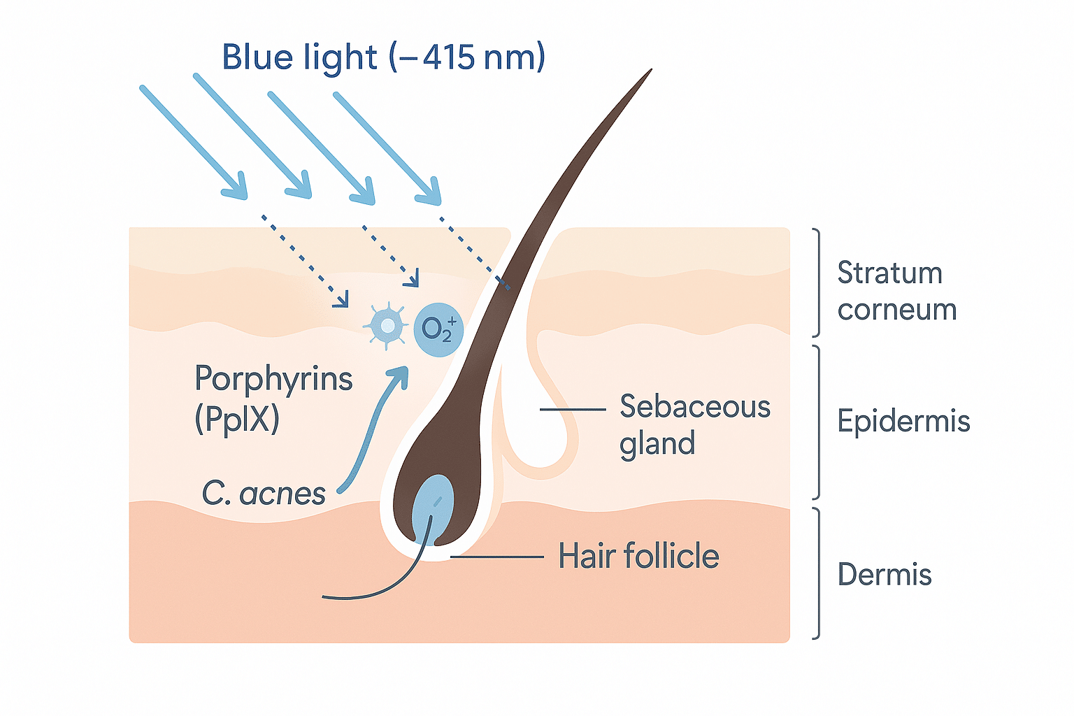Illustration of blue light interacting with acne bacteria porphyrins