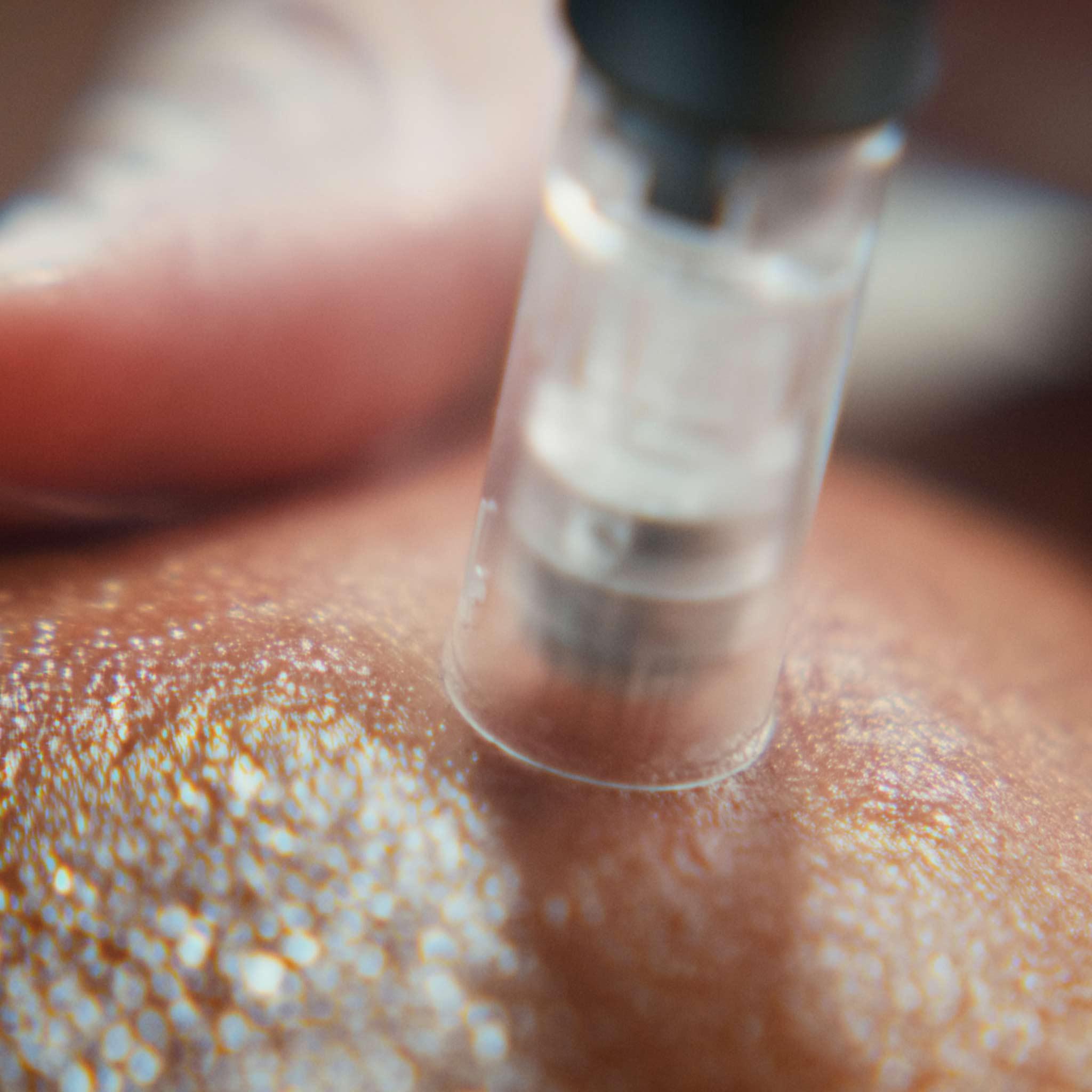 Close-up of healthy skin texture after professional microneedling treatment